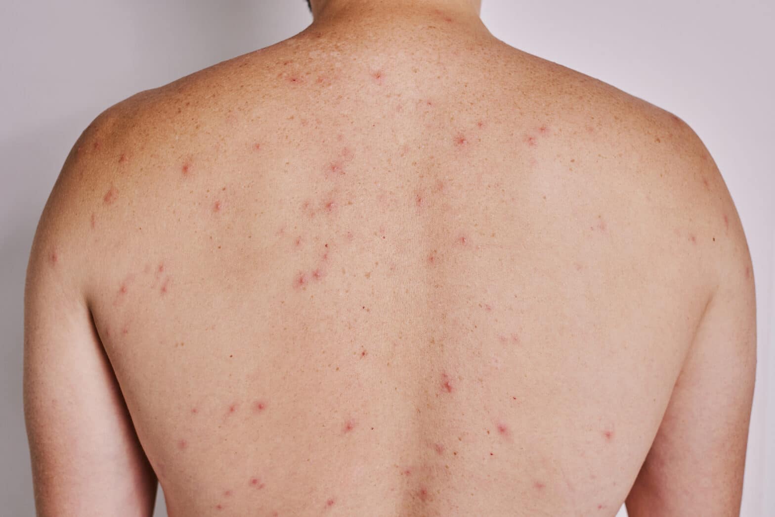 Comprendre l'acné dans le dos : causes, symptômes et traitements ...